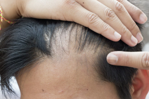 Врач сообщила о выпадении волос у переболевших COVID-19 пациентов